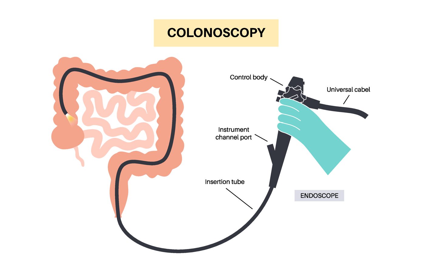 Diagram of a colonoscopy, showing the endoscope passing through the large bowel